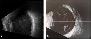 Comparación del patrón ecográfico en modo B en 2 casos de inflamación intraocular con ocupación vítrea. A) Endoftalmitis bacteriana confirmada tras Ozurdex®, mostrando ocupación vítrea difusa, múltiples puntos hiperecogénicos e imágenes de membrana. B) Endoftalmitis estéril (caso propio) con bandas vítreas densas, móviles y organizadas, intercaladas con espacios anecoicos.