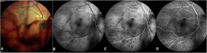 Imagen de fondo de ojo. Retinografía multicolor (A): Condensaciones vítreas difusas en patrón de «sábanas densas». Angiofluoresceinografía en tiempos: coroideo-arterial (B), arteriovenoso (C) y venoso (D), mostrando buen llenado con conservación del árbol vascular, sin áreas de isquemia ni enlentecimiento circulatorio. Se observan puntos hipofluorescentes dispersos por efecto de bloqueo, compatible con hemorragias retinianas aisladas.