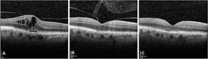 Tomografía de coherencia óptica con evolución temporal del perfil macular y del vítreo posterior. A) Preinyección: engrosamiento retiniano con edema macular quístico, leve desprendimiento subfoveal y hialoides posterior parcialmente adherida. B) Fase aguda (día 10 postinyección): resolución de espacios cistoideos y ocupación del vítreo posterior por densidades hiperreflectivas. C) Fase resolutiva (día 30 postinyección): recuperación completa del perfil foveal y aclaramiento del espacio vítreo.