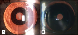 Opciones EDF de pequeña apertura. A)LIO IC-8 Apthera (Bausch & Lomb). B)Dispositivo de máscara XtraFocus (Morcher).
