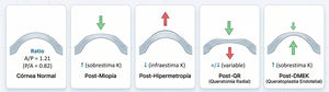 Representación esquemática del cambio en el ratio A/P según la cirugía corneal practicada. La dirección de la flecha indica el cambio en la curvatura, y el color, su repercusión en la potencia óptica corneal (verde=disminuye / rojo=aumenta potencia corneal).