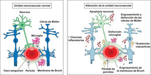 Integridad de la unidad neurovascular en condiciones fisiológicas y su alteración. Representación esquemática de la unidad neurovascular retiniana (UNV) en condiciones normales —izquierda— y en situación patológica —derecha—. En una UNV sana, las neuronas, las células gliales de Müller, la microglía, las células endoteliales, los pericitos y la membrana basal vascular —incluida la membrana de Bruch— se encuentran estrechamente coordinados para mantener la función neuronal, la estabilidad vascular y la integridad de la barrera hematorretiniana. Las células de Müller mantienen la homeostasis metabólica e iónica, la microglía permanece en un estado de vigilancia y los pericitos contribuyen al tono capilar y a la salud endotelial. En cambio, la alteración de la UNV se caracteriza por apoptosis neuronal, engrosamiento y disfunción de las células de Müller, activación microglial y pérdida de pericitos. Estos cambios se acompañan de un aumento de la liberación de citocinas inflamatorias, de las sustancias vasoactivas y de alteraciones estructurales como el engrosamiento de la membrana de Bruch. En conjunto, estas alteraciones deterioran el acoplamiento neurovascular, comprometen la función de barrera y favorecen la neurodegeneración retiniana progresiva y la enfermedad microvascular.