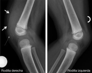Radiografía lateral de rodillas comparativa. Aumento de volumen y densidad inespecífico suprarrotuliano derecho (flechas gruesas); no se observan flebolitos ni lesión ósea. Pequeña calcificación en proyección a la rótula derecha que impresiona como osificación rotuliana inicial (flecha fina). ¿Aceleración de la maduración ósea comparativa? Pérdida de la definición normal del tendón del cuádriceps a la derecha versus el lado izquierdo (flecha curva).