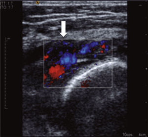 Ecografía Doppler de la rodilla derecha. Demuestra una lesión vascular sinovial con flujo de predominio venoso (flecha).