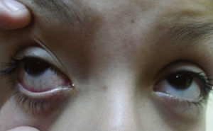 Congestión ocular secundaria a ojo seco.