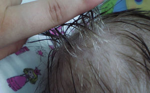 Coloración gris en tercio proximal de cabello.