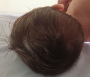 Fotografía del cabello del paciente a los 2 meses de terapia.
