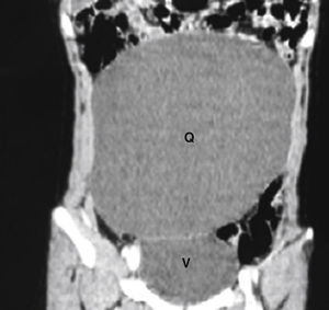 Tomografía computarizada abdominal que muestra la formación quística (Q) que ocupa gran parte del abdomen. Reconstrucción coronal. Se observa el desplazamiento lateral de asas.
