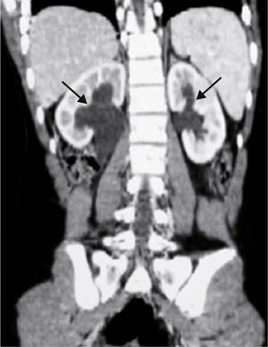 Tomografía computarizada, reconstrucción coronal posterior, que muestra hidroureteronefrosis bilateral secundaria a la compresión del quiste (flechas).