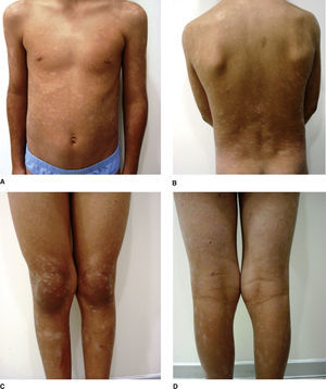 Máculas hipopigmentadas en (A) tronco, (B) espalda y (C, D) piernas.