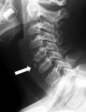 Radiografía cervical lateral, que muestra calcificación discal C5-C6 con protrusión ventral (flecha).