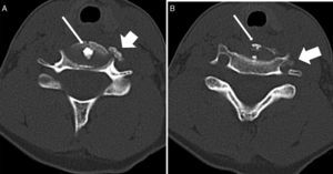 A y B. Tomografía computarizada, cortes axiales a nivel del disco C5-C6 con ventana ósea, donde se visualiza calcificación discal central (flecha fina) y protrusión antero-lateral izquierda que se extiende al agujero vertebral izquierdo (flecha gruesa).