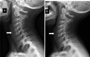 Controles seriados con radiografía cervical lateral. A. A los 2 meses demuestra significativa reducción del tamaño de las calcificaciones discales. B. A los 6 meses evidencia remisión completa de las calcificaciones discales.