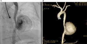 El angiograma muestra aneurisma gigante de la aorta torácica descendente.