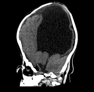 Tomografía cerebral sin contraste de corte sagital que muestra craneosinostosis y ventrículo único.