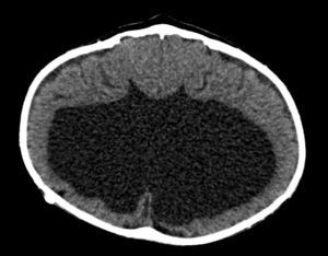 Tomografía cerebral sin contraste de corte transversal en donde se observa cráneo con incremento del diámetro transversal y disminución del anteroposterior, además de holoprosencefalia.