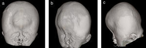 Reconstrucción multiplanar cefálica: cráneo en trébol (cráneo trilobular). A. Desplazamiento medial orbitario en relación con hipotelorismo. B. Abombamiento bitemporal asimétrico. C. Herniación frontal.