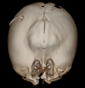 Reconstrucción tridimensional cefálica: evidenciándose cráneo en trébol, herniación frontal, cavidades orbitarias de poca profundidad desplazadas medialmente y catéter de derivación con ingreso frontal derecho.