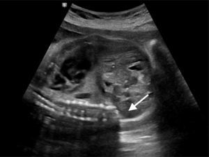 Ecografía prenatal de 22 semanas de edad gestacional. Defecto mayor de la columna lumbosacra (flecha) Agenesia caudal parcial.
