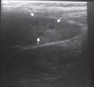 Ecotomografía de bazo con lesiones hipoecogénicas de aproximadamente 4mm sugerentes de abscesos.