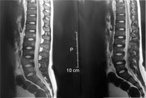 Resonancia magnética de columna vertebral en secuencia T1 que evidencia imágenes hiperintensas en las vértebras dorsolumbares multisegmentarias con aspecto inflamatorio.