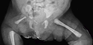 Imagen radiográfica que muestra hipoplasia de fémur derecho con techo acetabular y pelvis displásicos ipsilaterales.