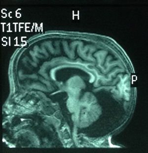Resonancia magnética cerebral en corte sagital. Se observa una evidente disminución del tamaño del cerebelo y la consecuente megacisterna magna.