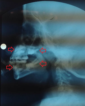 Radiografía lateral de cráneo. Se destaca en flechas rojas la formación de la corona de los incisivos superiores e inferiores y de los primeros molares superiores e inferiores. Debido a la sobreproyección de estructuras no es posible establecer con certeza la lateralidad de los dientes observados en la radiografía.
