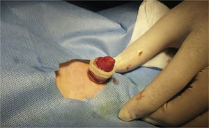Posterior al procedimiento se deja sitio quirúrgico con ungüento oftálmico y Surgicel®.
