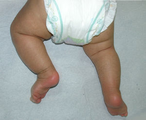 Ictiosis vulgar en niño de 11 meses. Se observa compromiso de extremidades inferiores que respeta los pliegues.