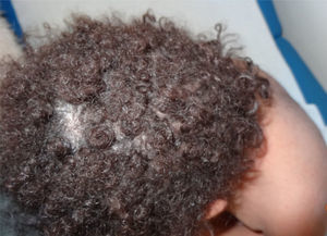 Apariencia del pelo en Síndrome de Netherton.