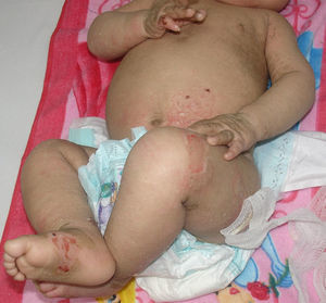 Ictiosis epidermolítica en paciente de 6 meses.