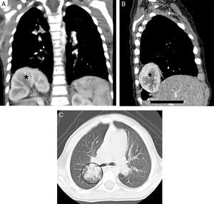 A, B y C corresponden a reconstrucciones de TC coronal posterior, parasagital derecha e imagen axial en ventana pulmonar al nivel de la carina. Se observa imagen intratorácica sólida ovoidea basal posterior derecha (asterisco en A y B) y un pequeño foco de condensación pulmonar parahiliar derecho (C).