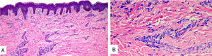 A. Epidermis con ortoqueratosis y espongiosis. Dermis con leve edema e infiltrado perivascular superficial linfocitario. B. Con tinción de Giemsa aumento de mastocitos perivasculares.