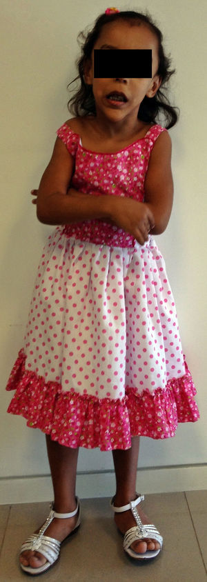 Paciente con síndrome de Sotos. Nótese la talla alta, fascies triangulares particulares, frente amplia y mandíbula prominente.