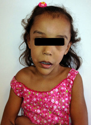 Hallazgos faciales relevantes en paciente con SS: cara larga, frente amplia con línea de pelo frontotemporal elevada, fisura palpebral alargada, filtrum largo y mandíbula prominente.