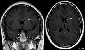 RM cerebral con cortes coronal y axial T1. Gadolinio que muestra (flechas) un angioma venoso, con venas medulares dilatadas en ubicación periventricular frontal derecha, que drenan a una vena colectora subependimaria.