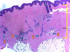 Histopatología de lesión de piel: 1. Atrofia de folículo piloso. 2. Infiltrado inflamatorio linfocitario, con presencia de algunas células plasmáticas alrededor de las glándulas ecrinas, donde aún quedan algunos adipocitos. 3. Glándulas ecrinas con total reemplazo del tejido adiposo por colágeno. 4. Tejido adiposo subcutáneo rodeado por haces de colágeno. La línea roja marca el espesor dérmico normal y la línea amarilla la expansión del colágeno, con haces engrosados, eosinofílicos.