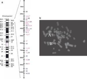 Cromosoma 1 y deleción 1p36 de tipo terminal. A. Se presenta la localización de una deleción de tipo terminal en el cromosoma 1, brazo corto (p), banda 6, región 3 (1p36). B. Estudio de hibridación in situ con fluorescencia (FISH) en fase metafase de un caso estudiado en México. Se puede observar cómo las señales telomérica y subtelomérica están ausentes en el cromosoma con la microdeleción terminal 1p36 (flecha A), y presentes en el homólogo normal (flecha B). Fuente: reproducido de Heilstedt et al.9 (A) y Villarroel et al.5 (B) con autorización.