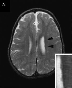 Heterotopia nodular periventricular. La figura corresponde a la resonancia magnética de un paciente con diagnóstico de síndrome de deleción 1p36. Fuente: reproducido de Blennow et al.19 con autorización.