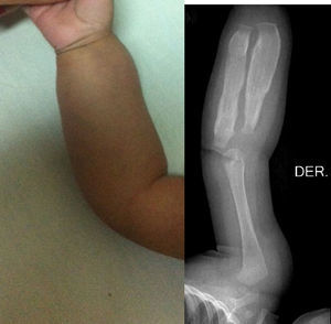 Brazo derecho. Estudio radiográfico de brazo derecho; proyección AP que demuestra el engrosamiento cortical del radio y el cúbito. Nótese la disminución en la medular. Los núcleos de osificación y las epífisis no presentan cambios.