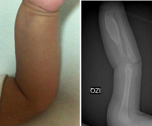 Brazo izquierdo. Estudio radiográfico de brazo izquierdo. Proyección AP que demuestra el engrosamiento cortical del radio. Los núcleos de osificación y las epífisis no presentan cambios.