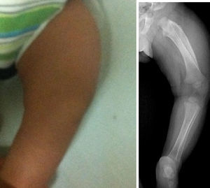 Pierna izquierda. Estudio radiográfico de pierna izquierda. Proyección AP que demuestra afección severa en el fémur izquierdo. Nótese hiperostosis discreta en la cara anterior de la tibia izquierda y el engrosamiento cortical del radio. Los núcleos de osificación y las epífisis no presentan cambios.