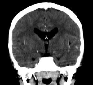 Corte coronal de tomografía que muestra ausencia del septum pellucidum (A).