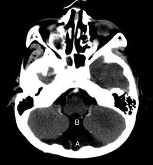 Corte axial de tomografía que muestra separación de los hemisferios cerebelosos por comunicación entre la fosa posterior (A) y el cuarto ventrículo aumentado de tamaño (B).