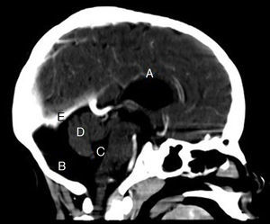 Corte sagital de tomografía que muestra agenesia del cuerpo calloso (A), fosa posterior normal (B), comunicación con el cuarto ventrículo levemente aumentado de tamaño (C), vermis cerebeloso que muestra hipoplasia parcial (D), sin elevación del tentorio (E).