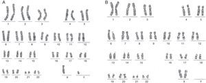 Cariotipo bandas G del paciente y su madre. A. Nótese que los cromosomas 1 son de diferente tamaño y que los cromosomas 6 son de similar tamaño. B. Nótese que los cromosomas 1 son de diferente tamaño y que los cromosomas 6 también son de diferente tamaño.