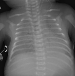 Radiografía de tórax a los 7 días con velamiento difuso y broncograma aéreo. Paciente con ventilación de alta frecuencia oscilatoria y óxido nítrico inhalado.