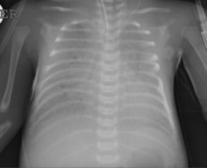 Radiografía de tórax a los 19 días con velamiento difuso y broncograma aéreo. Paciente con ventilación de alta frecuencia oscilatoria.