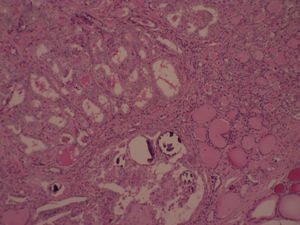 Cuerpos de Psammoma en los ejes de las papilas y en asociación con células neoplásicas. Aumento 5×; tinción hematoxilina-eosina.